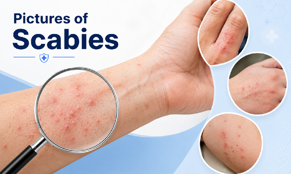 pictures of scabies